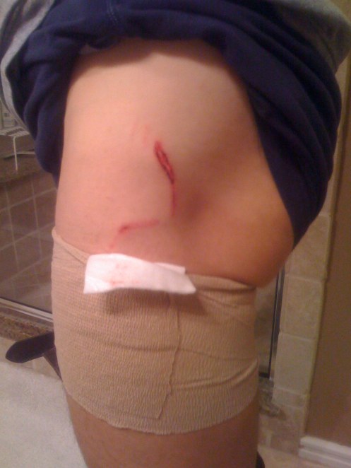 200901XX Dog Bite #1