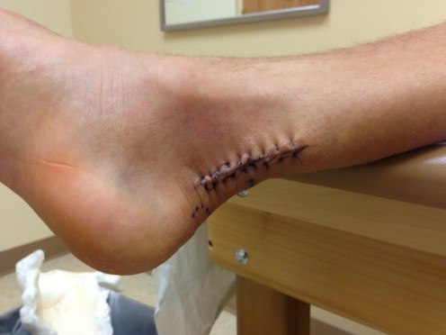 Part man, part centipede.  The two ends of the snapped achilles were sewn back together right under that mess.
